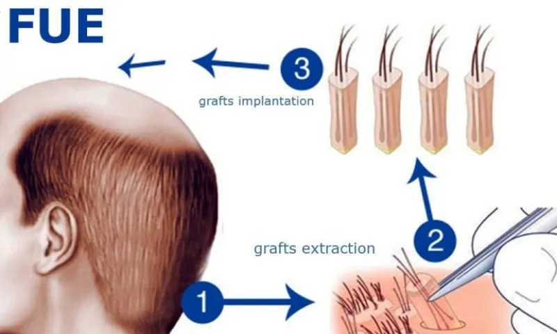 FUE haartransplantatie Grafts