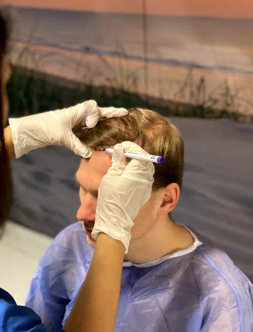 Inhammen haartransplantatie