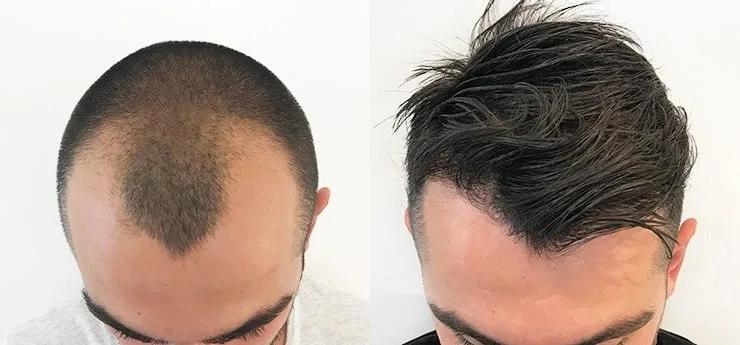 Haartransplantatie behandeling voor en na