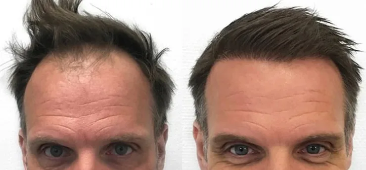 Haartransplantatie behandeling voor en na