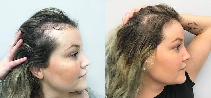 Haartransplantatie vrouwen behandeling voor en na